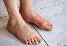 بيماری های سيستميک پا بيماری های سيستميک پا